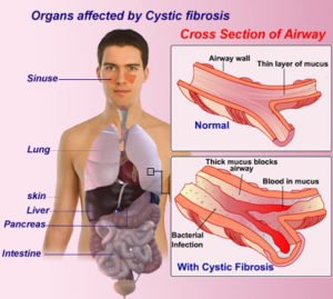 cystic-fibrosis-organ