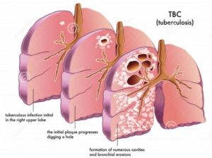 TB-Degradation